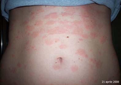 pytiriasis